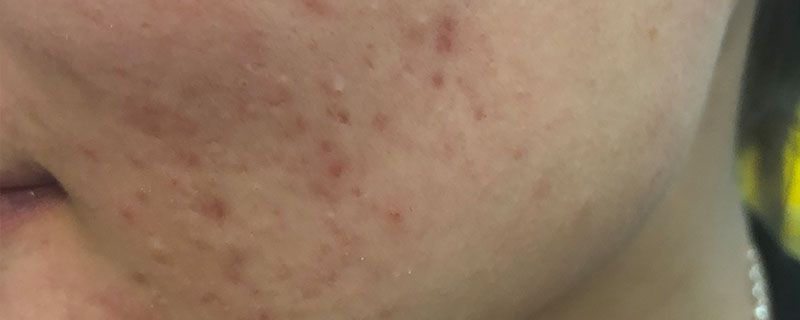 脸上有痘印毛孔粗大怎么办 毛孔 第1张
