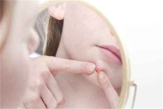 挤完痘痘可以用爽肤水吗 爽肤水 护肤品 第3张