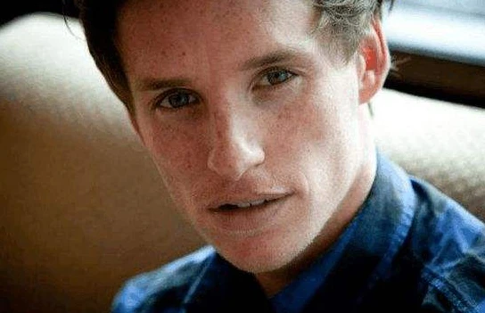 雀斑和黄褐斑的区别 雀斑 黄褐斑 第3张