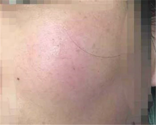 脸部是否真的过敏，其实是角质层薄 角质层薄 美白祛黄 第3张