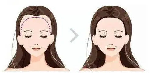 正常m型发际线是怎么样的 发际线 m型发际线 美妆 第2张