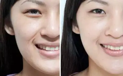 为什么年纪小就有法令纹 法令纹 去除法令纹 美妆 第2张