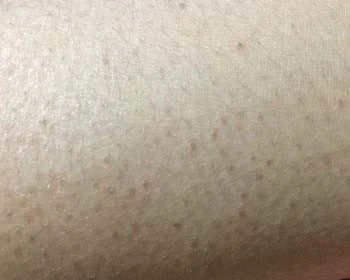 去除鸡皮肤的小知识教你轻松祛除鸡皮肤 鸡皮肤 美白祛黄 第3张