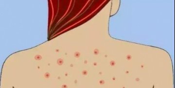 背部毛孔粗大怎么解决 毛孔 背部毛孔粗大 美妆 第1张 背部毛孔粗大怎么解决 毛孔 背部毛孔粗大 美妆 第1张