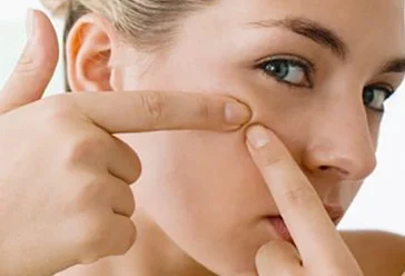 痘痘肌用什么护肤品对皮肤好 痘痘肌 痘痘肌护肤品 美妆 第3张