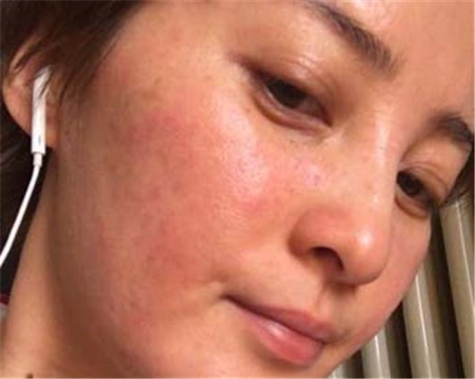 脸部是否真的过敏，其实是角质层薄 角质层薄 美白祛黄 第1张