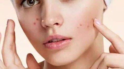 油皮痘痘肌怎么改善 油皮 痘痘肌 美妆 第1张