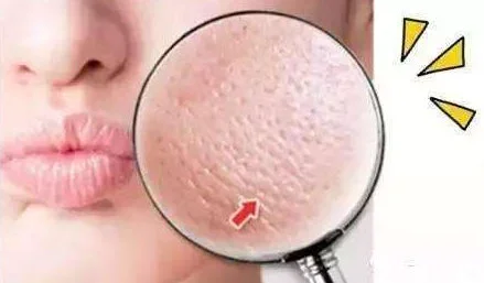 皮肤毛孔大怎么解决 毛孔大 毛孔大解决方法 美妆 第2张