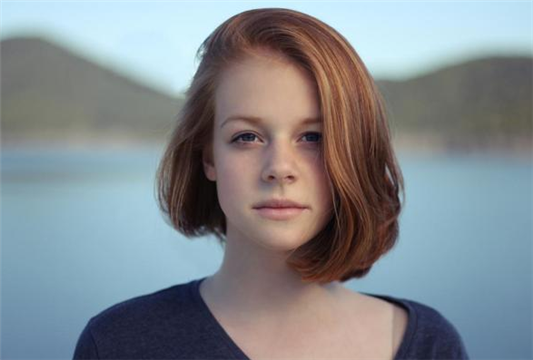 黄褐斑和雀斑的区别 黄褐斑 雀斑 第1张