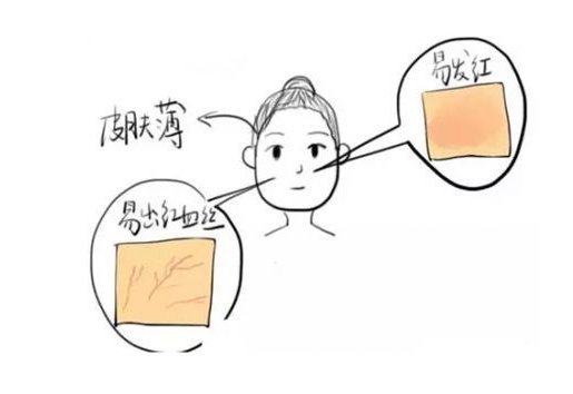 角质层薄怎么修复增厚 角质层 角质层薄 美妆 第1张