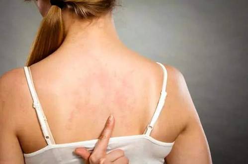 背上长了很多痘痘怎么办 痘痘 背长痘 美妆 第1张