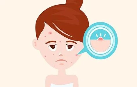 致痘的护肤品成分都有哪些 致痘 致痘成分 美妆 第1张 致痘的护肤品成分都有哪些 致痘 致痘成分 美妆 第1张