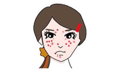 维胺酯维e乳膏能去痘痘吗 祛痘 祛痘方法 美妆 第1张 维胺酯维e乳膏能去痘痘吗 祛痘 祛痘方法 美妆 第1张