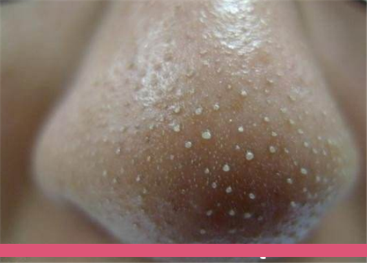 卸妆水去黑头有效果吗，卸妆水能去黑头吗 黑头 第1张