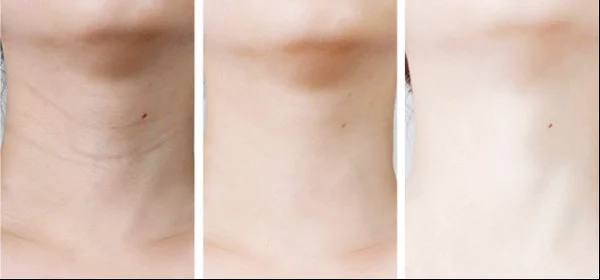 颈纹很深很难看怎么办 颈纹 颈纹解决方法 美妆 第3张