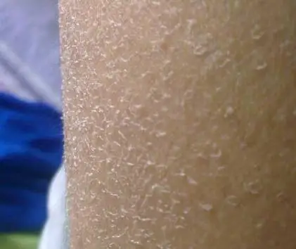 冬天洗澡后有皮屑是怎么办 洗澡 洗澡起皮 美妆 第2张