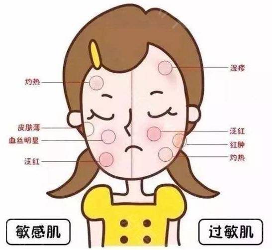 红敏肌自己怎么改善 红敏肌 改善红敏肌 美妆 第1张