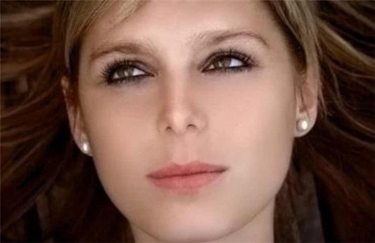 黄褐斑与晒斑的区别 黄褐斑 晒斑 第4张