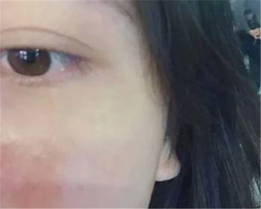 脸部是否真的过敏，其实是角质层薄 角质层薄 美白祛黄 第2张