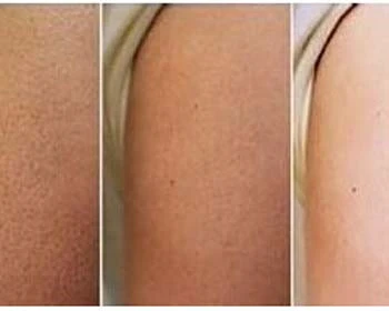 去除鸡皮肤的小知识教你轻松祛除鸡皮肤 鸡皮肤 美白祛黄 第4张