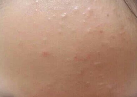 用护肤品起小米粒疙瘩怎么回事 过敏 小米粒疙瘩 美妆 第1张
