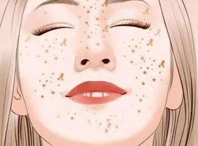 祛斑晒斑黄褐斑怎么办 晒斑 黄褐斑 美妆 第3张