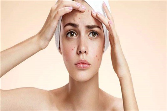 挤痘后多久可以敷面膜 面膜 护肤品 第1张