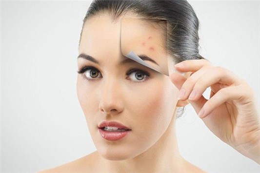 闭口粉刺形成的原因是什么 闭口粉刺 第1张