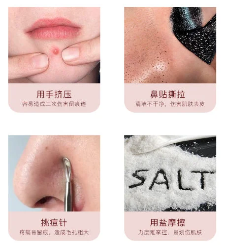 挤黑头挤出来的白色东西是什么 黑头 挤黑头 美妆 第2张