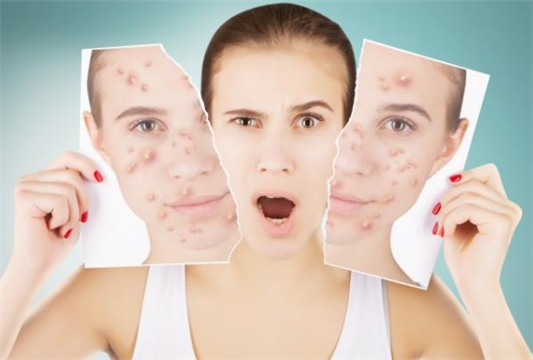 粉刺和痘痘的区别 粉刺 痘痘 第1张 粉刺和痘痘的区别 粉刺 痘痘 第1张