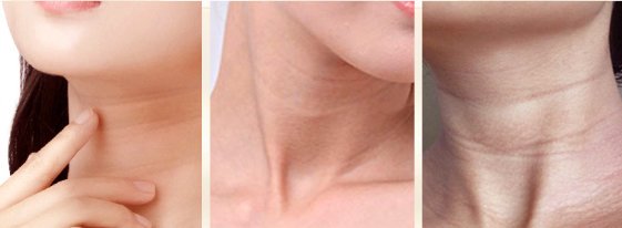 颈纹很深怎么办二十岁 颈纹 颈纹护肤 美妆 第1张