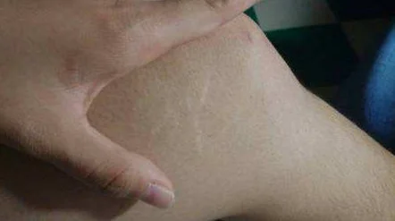 皮肤撑开长纹怎么消除 祛纹 皮肤撑开长纹 美妆 第2张