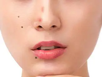 点完痣后留下红印和坑怎么办 点痣 点痣修复 美妆 第3张