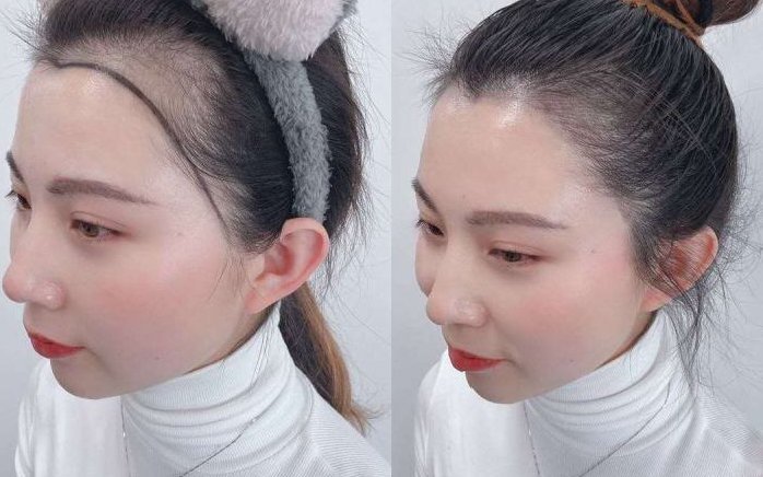 再生发际线真的可以再生么 发际线 再生发际线 美妆 第1张