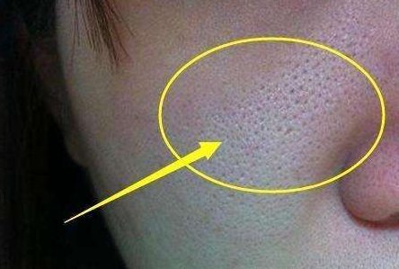 皮肤毛孔大怎么解决 毛孔大 毛孔大解决方法 美妆 第1张