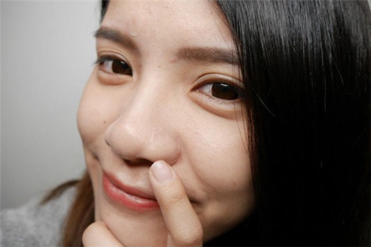 怎样防止痘痘增加 祛痘 第1张