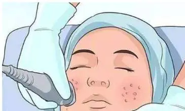 微针收缩毛孔效果怎样 微针 收缩毛孔 美妆 第3张 微针收缩毛孔效果怎样 微针 收缩毛孔 美妆 第3张