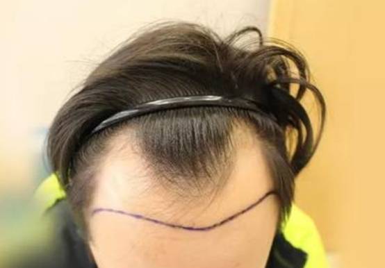 正常m型发际线是怎么样的 发际线 m型发际线 美妆 第1张