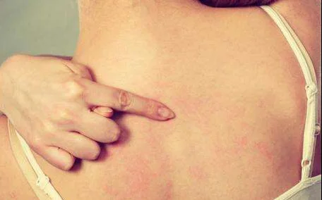 背部毛孔粗大怎么解决 毛孔 背部毛孔粗大 美妆 第3张 背部毛孔粗大怎么解决 毛孔 背部毛孔粗大 美妆 第3张