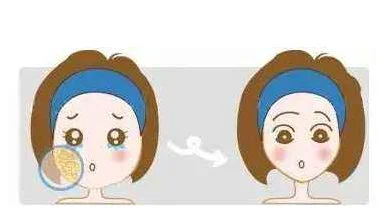 打完溶脂针注意事项 溶脂针 溶脂针注意事项 美妆 第3张 打完溶脂针注意事项 溶脂针 溶脂针注意事项 美妆 第3张