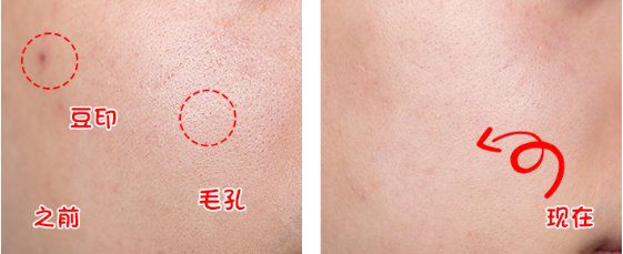 悦木之源祛痘凝胶效果怎么样 祛痘凝胶 悦木之源祛痘凝胶 美妆 第1张