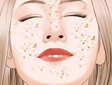 为什么黄褐斑不能皮秒 皮秒 黄褐斑 美妆 第2张