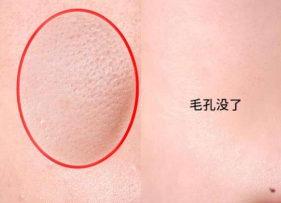 简单的收缩毛孔方法 收缩毛孔 收缩毛孔方法 美妆 第1张