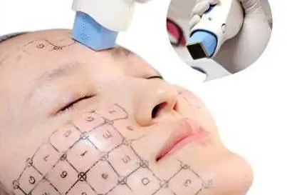 热玛吉副作用和危害都有哪些 热玛吉 热玛吉副作用 美妆 第2张