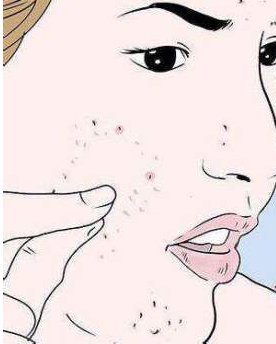 挤完粉刺痘痘可以敷面膜吗 敷面膜 挤完粉刺面膜 美妆 第1张