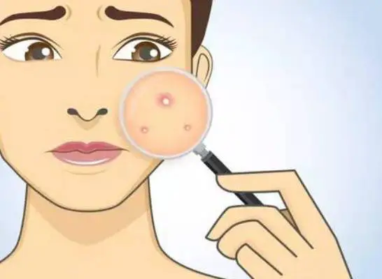 化妆品中致痘成分有哪些 化妆品 致痘成分 美妆 第2张