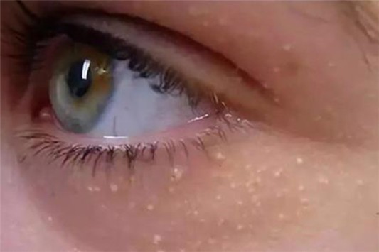 去脂肪粒最有效的药膏 药膏 盐酸金霉素眼膏 第1张