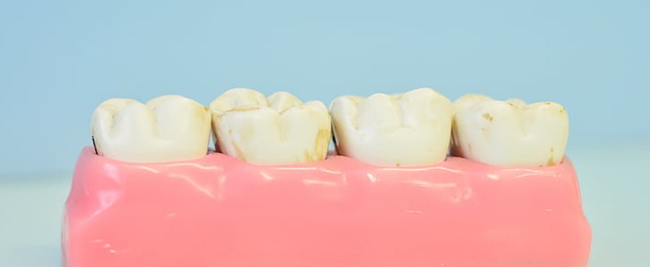 牙齿变白的方法 牙齿 变白 美妆 第3张