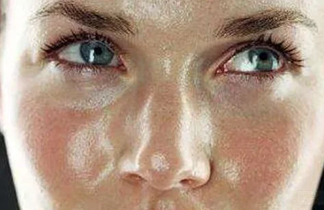 油皮痘痘肌怎么改善 油皮 痘痘肌 美妆 第2张