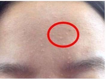 额头老是长闭口是什么原因 闭口 额头长闭口 美妆 第1张 额头老是长闭口是什么原因 闭口 额头长闭口 美妆 第1张